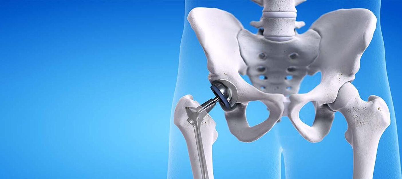 Best Hip Replacement Surgeon in Delhi for Advanced Joint Care